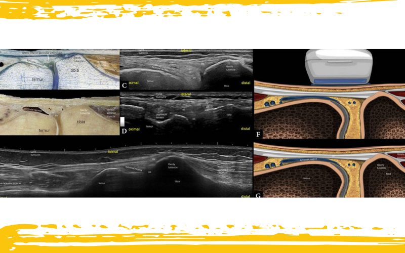 compartimento-lateral-rodilla-y-ecografia-tempo-formaci-n